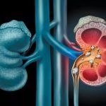 Có thể đập tan sỏi thận bằng cách uống càng nhiều nước càng tốt